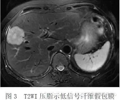 【病例】肝脏上皮样血管内皮瘤1例CT影像表现与鉴别