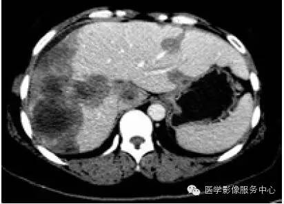 【病例】肝脏上皮样血管内皮瘤1例CT影像表现与鉴别