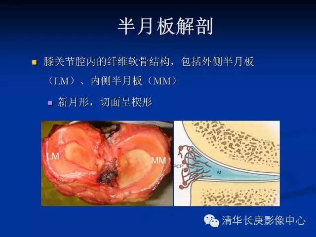 半月板的MR评价