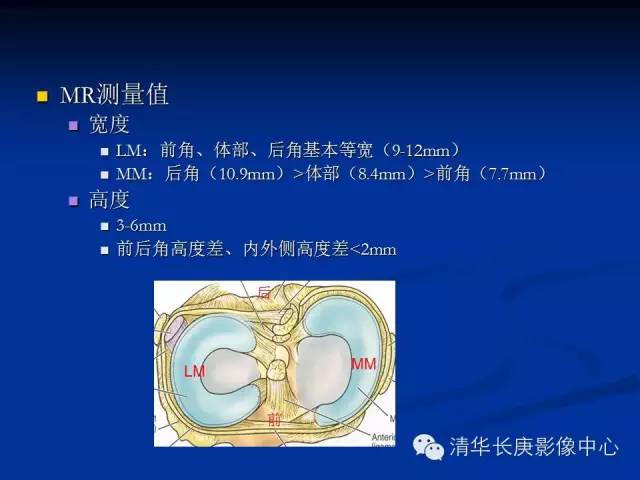 半月板的MR评价 半月板的MR评价