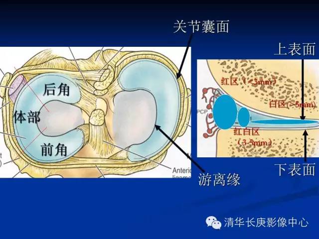 半月板的MR评价 半月板的MR评价