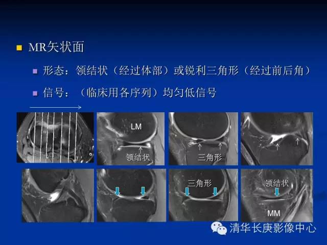 半月板的MR评价 半月板的MR评价