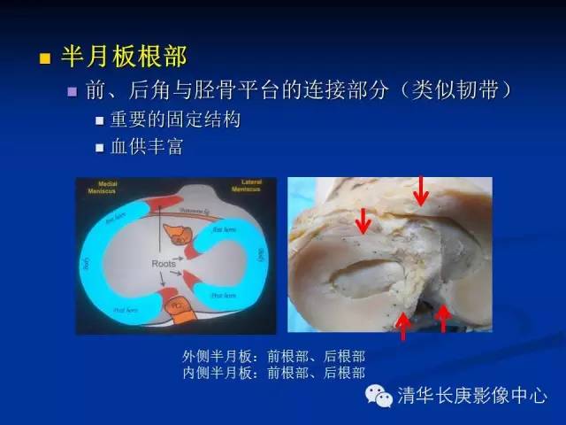 半月板的MR评价 半月板的MR评价