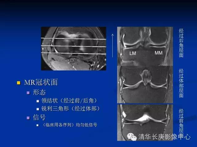 半月板的MR评价 半月板的MR评价