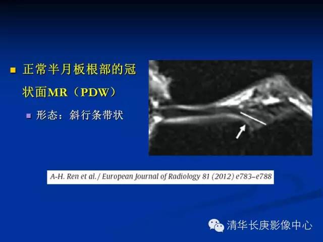 半月板的MR评价 半月板的MR评价