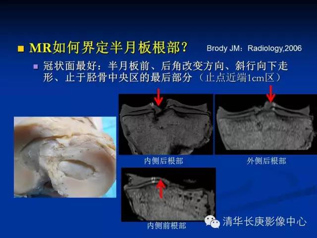 半月板的MR评价 半月板的MR评价
