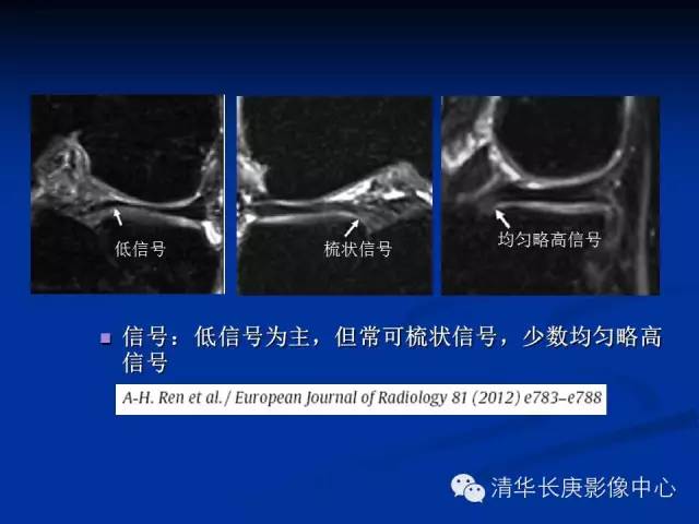 半月板的MR评价 半月板的MR评价