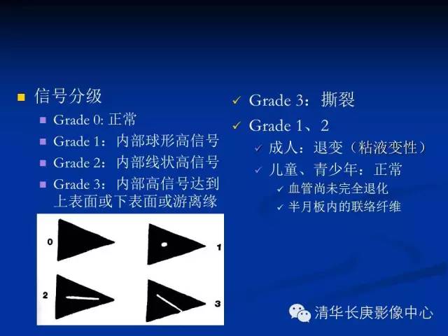 半月板的MR评价 半月板的MR评价