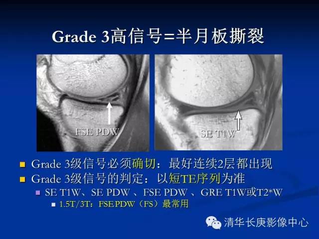 半月板的MR评价 半月板的MR评价