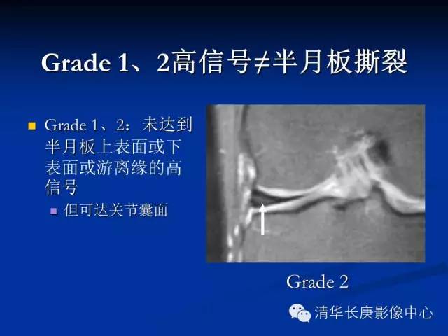 半月板的MR评价 半月板的MR评价