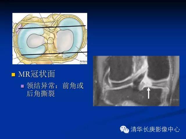 半月板的MR评价 半月板的MR评价
