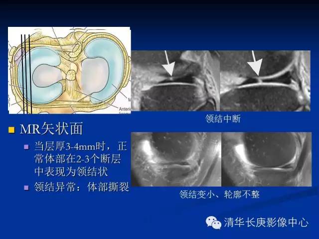 半月板的MR评价 半月板的MR评价
