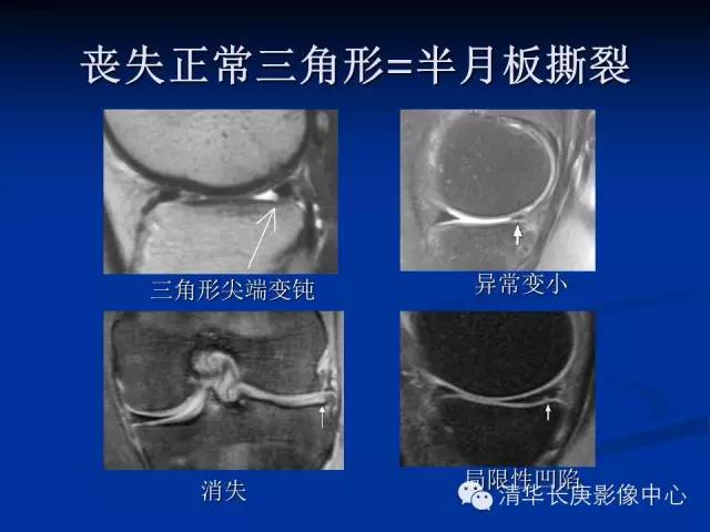 半月板的MR评价 半月板的MR评价