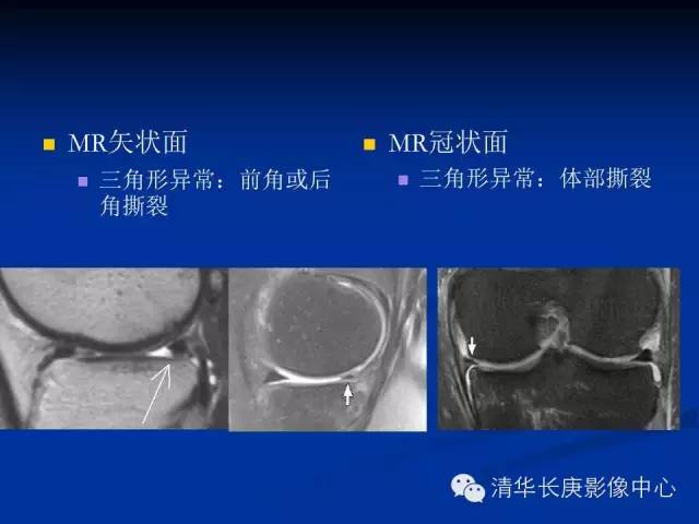 半月板的MR评价 半月板的MR评价