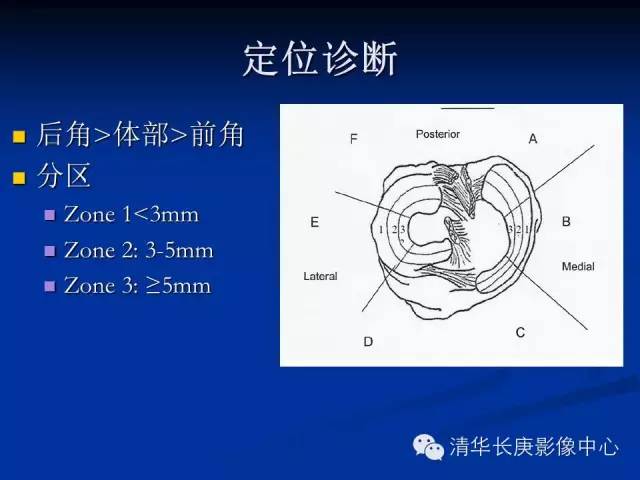 半月板的MR评价 半月板的MR评价