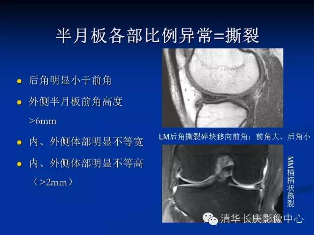 半月板的MR评价 半月板的MR评价