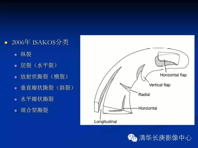 半月板的MR评价 半月板的MR评价