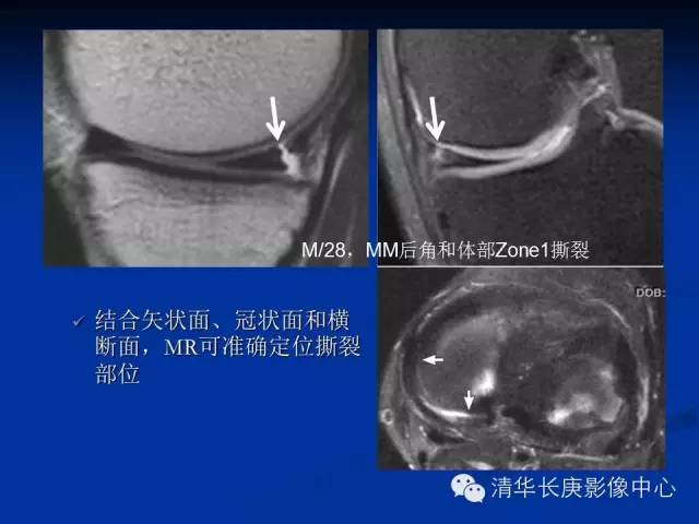 半月板的MR评价 半月板的MR评价