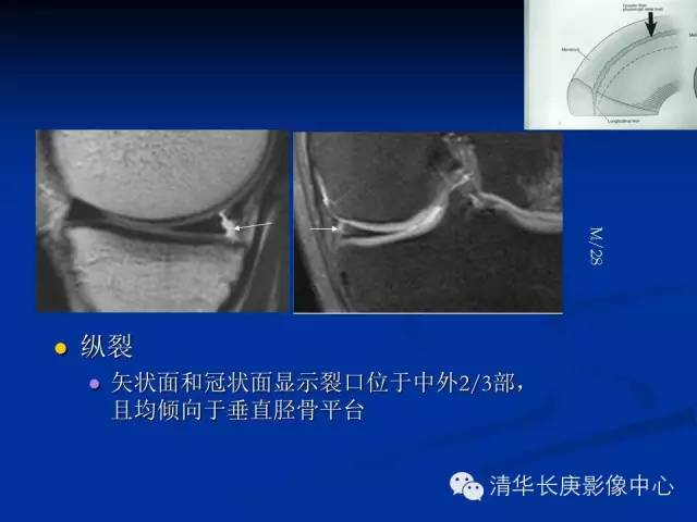 半月板的MR评价 半月板的MR评价