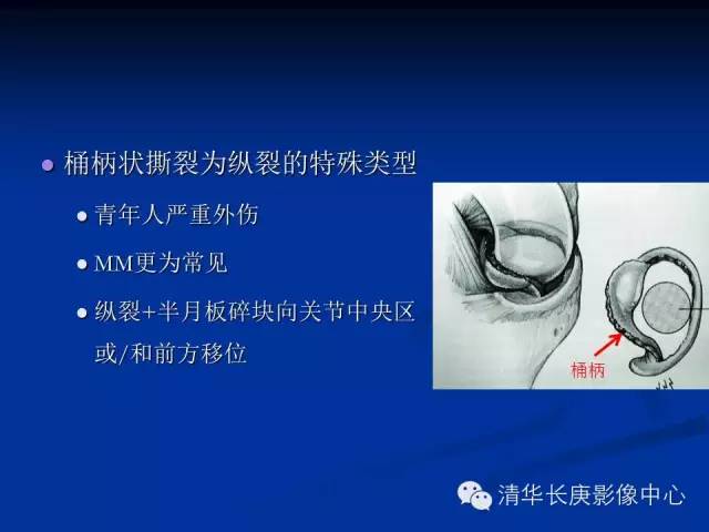 半月板的MR评价 半月板的MR评价