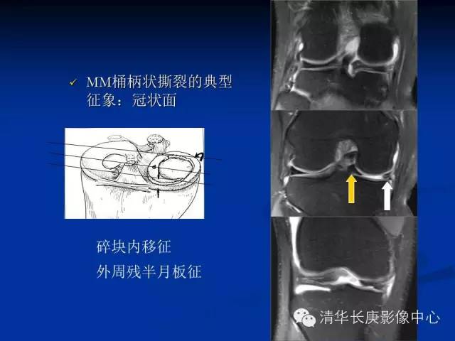 半月板的MR评价 半月板的MR评价