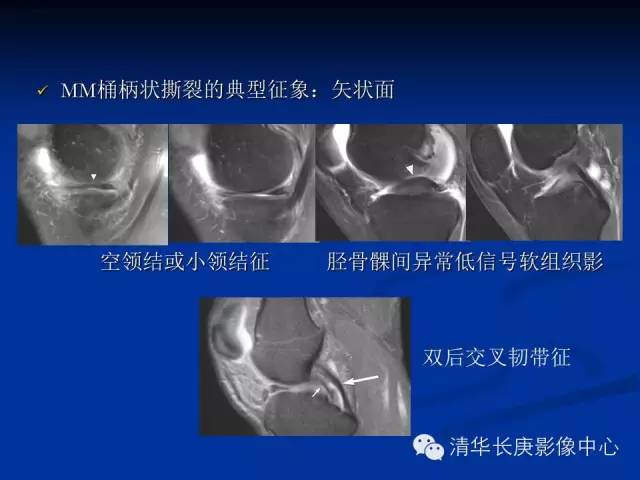 半月板的MR评价 半月板的MR评价