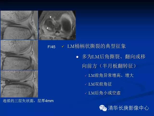 半月板的MR评价 半月板的MR评价