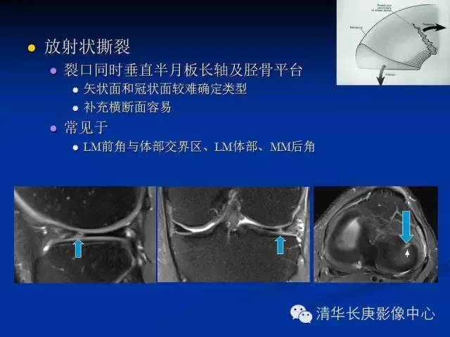 半月板的MR评价 半月板的MR评价