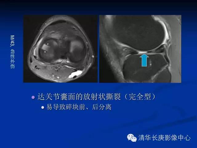 半月板的MR评价 半月板的MR评价