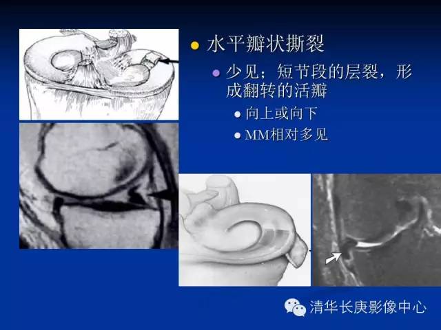 半月板的MR评价 半月板的MR评价