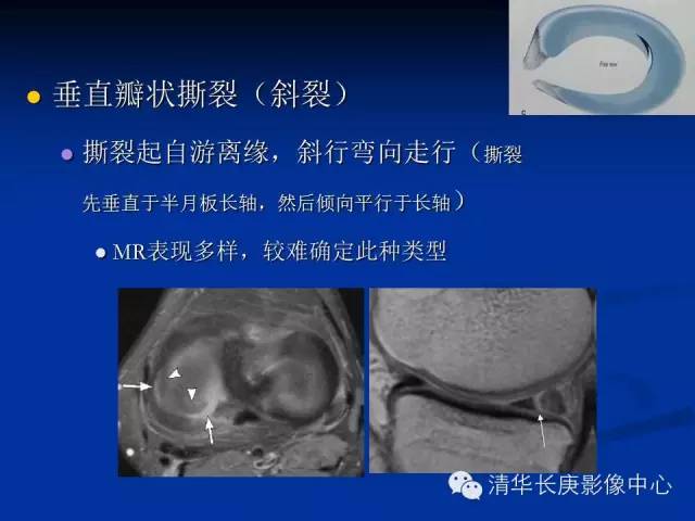 半月板的MR评价 半月板的MR评价