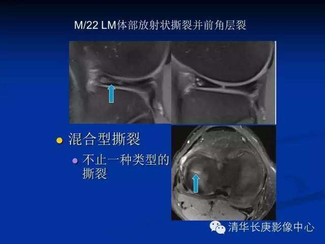 半月板的MR评价 半月板的MR评价