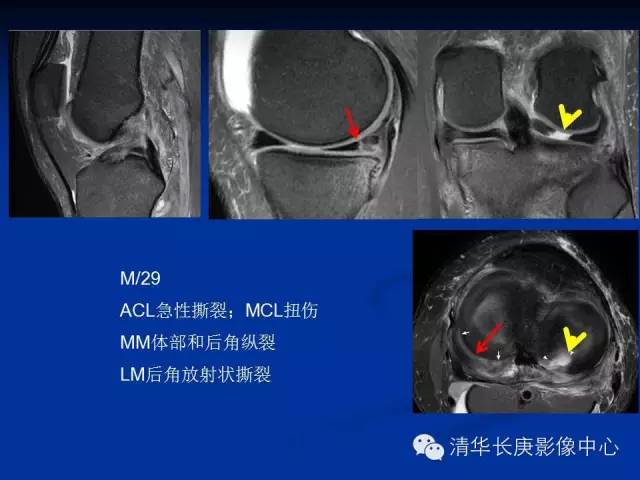 半月板的MR评价 半月板的MR评价