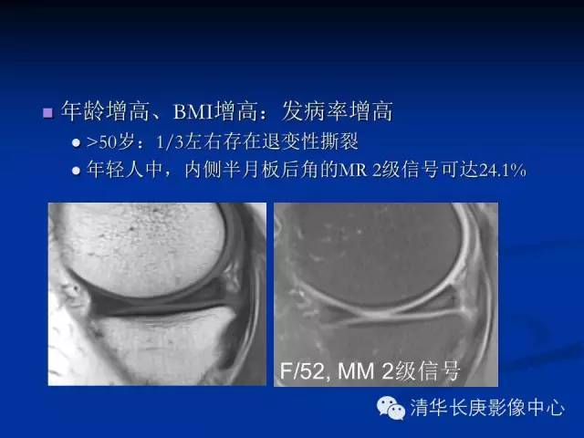 半月板的MR评价 半月板的MR评价