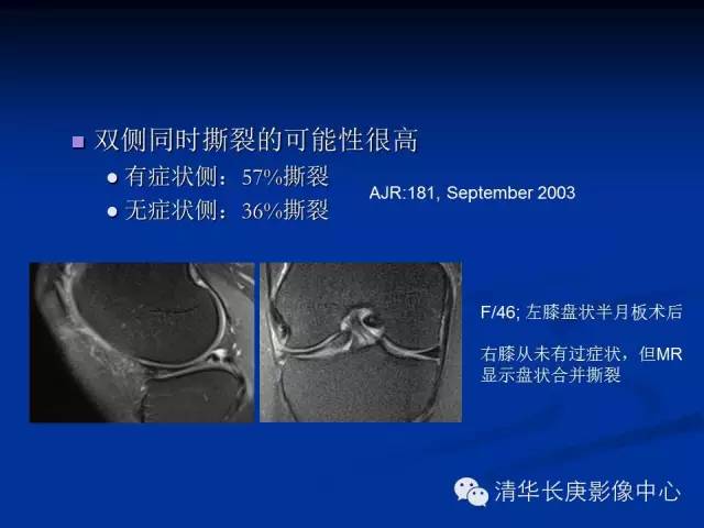 半月板的MR评价 半月板的MR评价