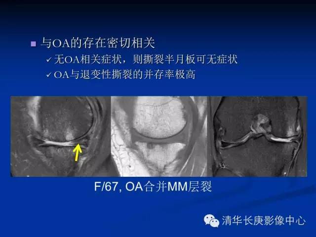 半月板的MR评价 半月板的MR评价