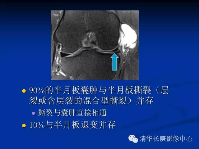 半月板的MR评价 半月板的MR评价
