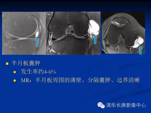 半月板的MR评价 半月板的MR评价