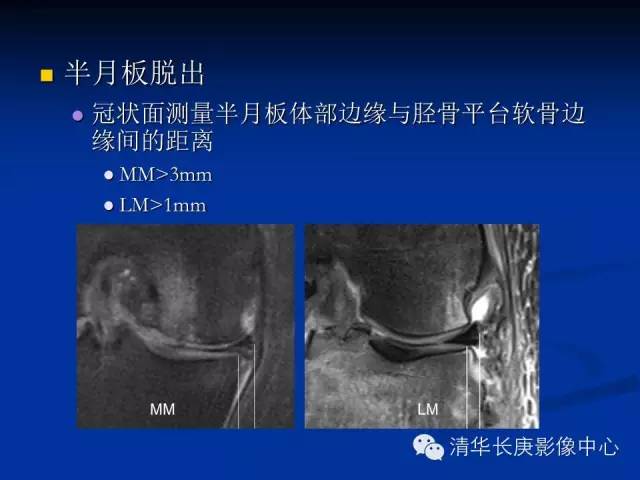 半月板的MR评价 半月板的MR评价