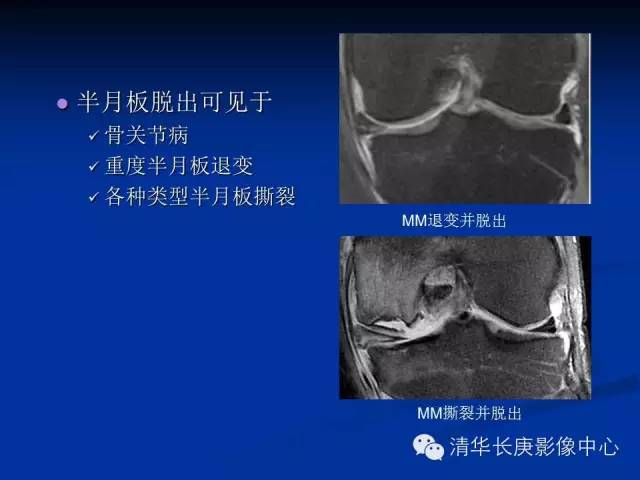 半月板的MR评价 半月板的MR评价