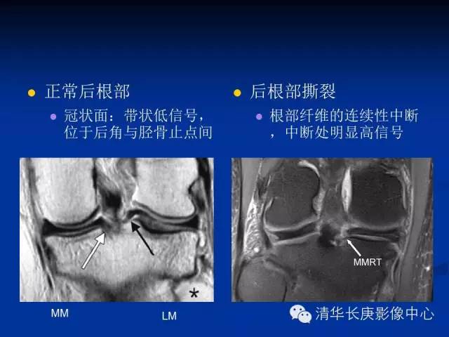半月板的MR评价 半月板的MR评价