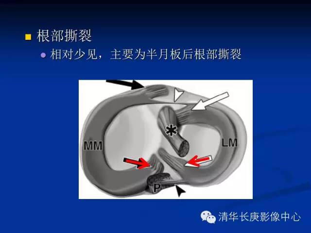 半月板的MR评价 半月板的MR评价