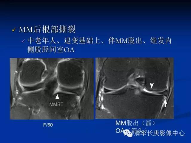 半月板的MR评价 半月板的MR评价
