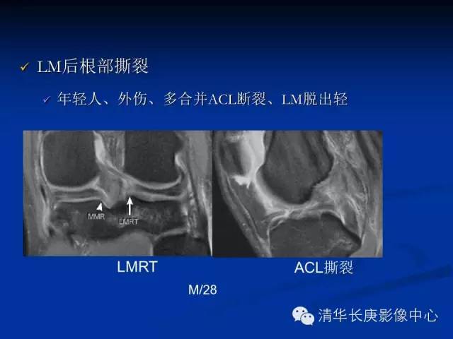 半月板的MR评价 半月板的MR评价