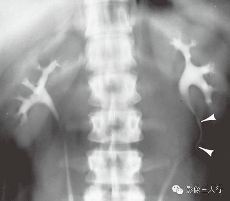 输尿管移位这个征象你注意了吗？