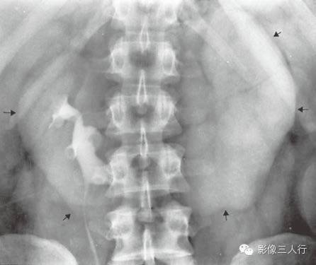输尿管移位这个征象你注意了吗？