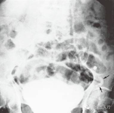 输尿管移位这个征象你注意了吗？