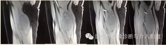 【病例】滑膜肉瘤2例CT及MR影像表现与鉴别 【病例】滑膜肉瘤2例CT及MR影像表现与鉴别