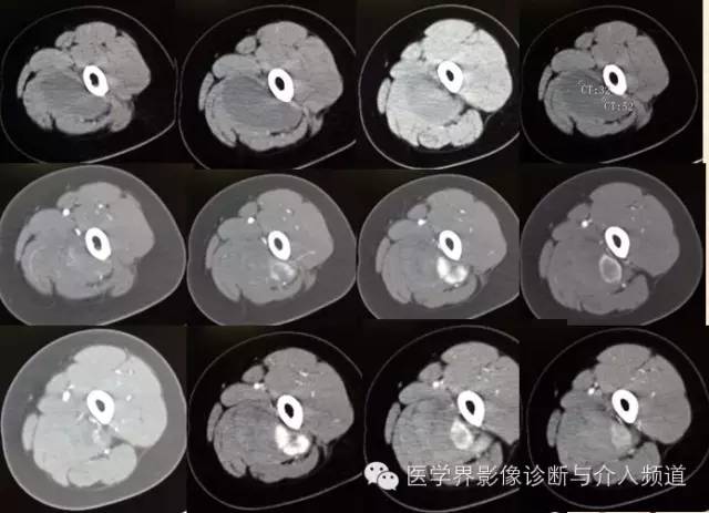 【病例】滑膜肉瘤2例CT及MR影像表现与鉴别