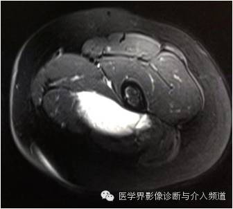 【病例】滑膜肉瘤2例CT及MR影像表现与鉴别 【病例】滑膜肉瘤2例CT及MR影像表现与鉴别